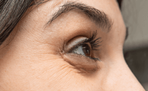 Woman with tired eyes in need of dermal filler treatment