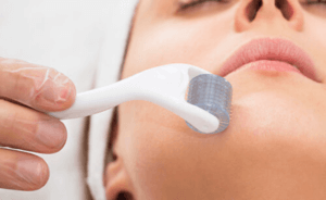 Microneedling up close