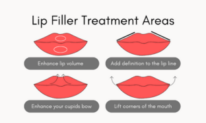 lip filler treatment areas - Suffolk skin clinic