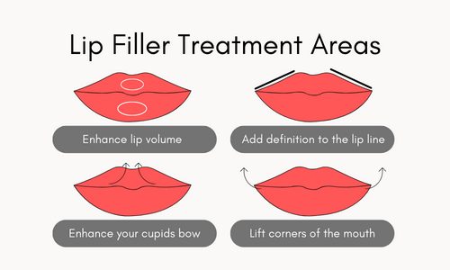 lip filler treatment areas diagra,