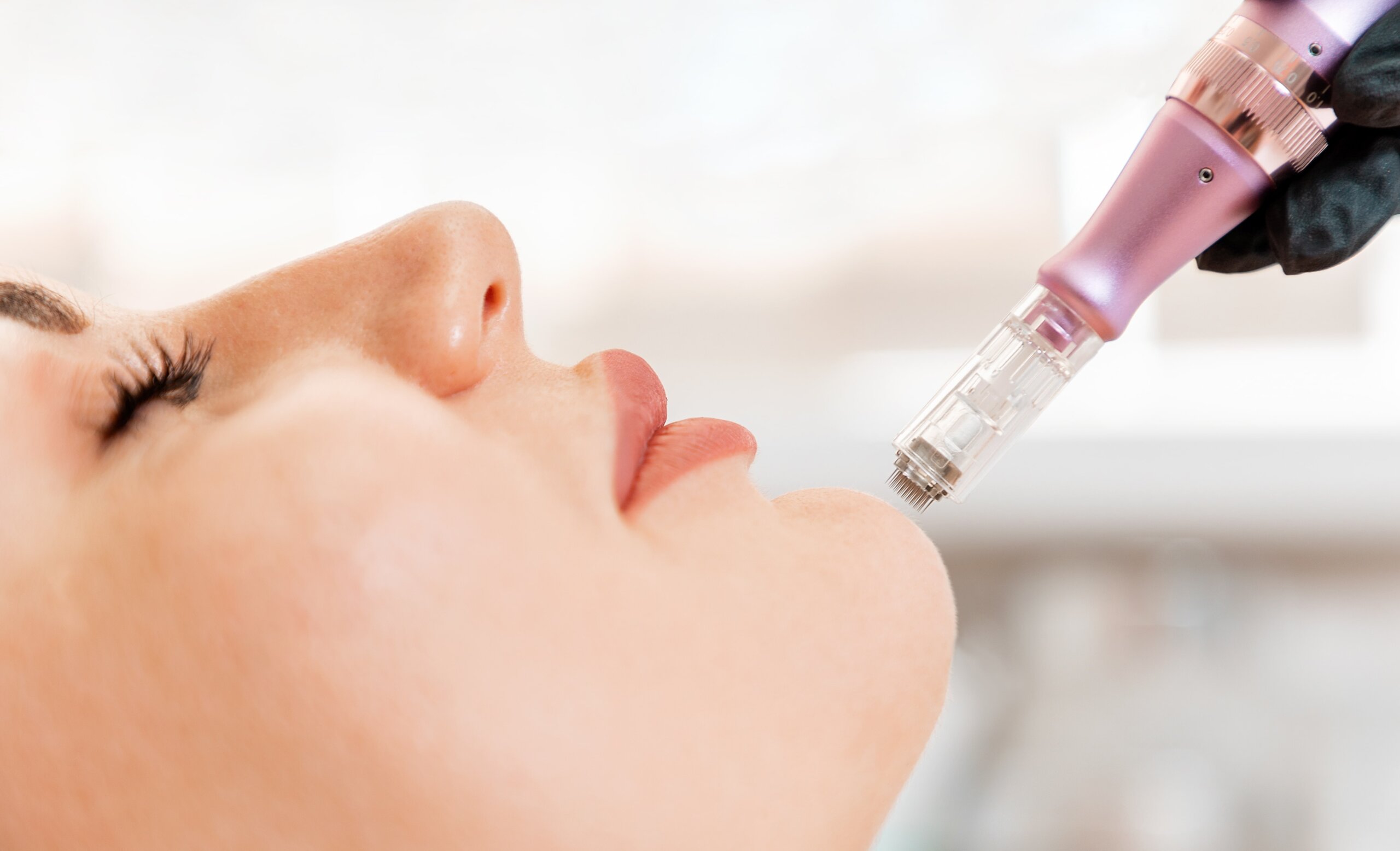 Woman getting Microneedling