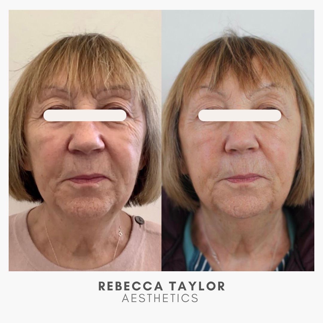 Facial Treatments Suffolk | Facials Suffolk | Aesthetics Clinic Suffolk
