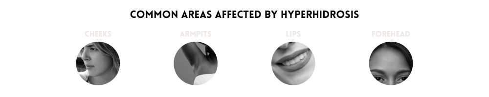 Areas affected by Hyperhidrosis - Suffolk skin clinic