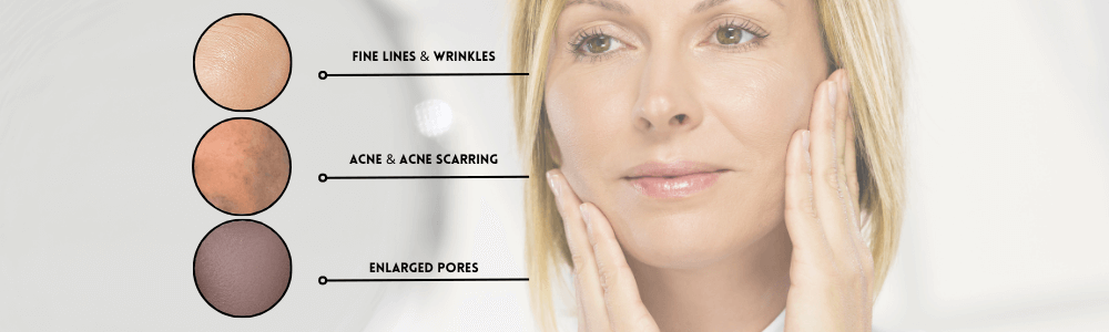 microneedling skin concerns diagram