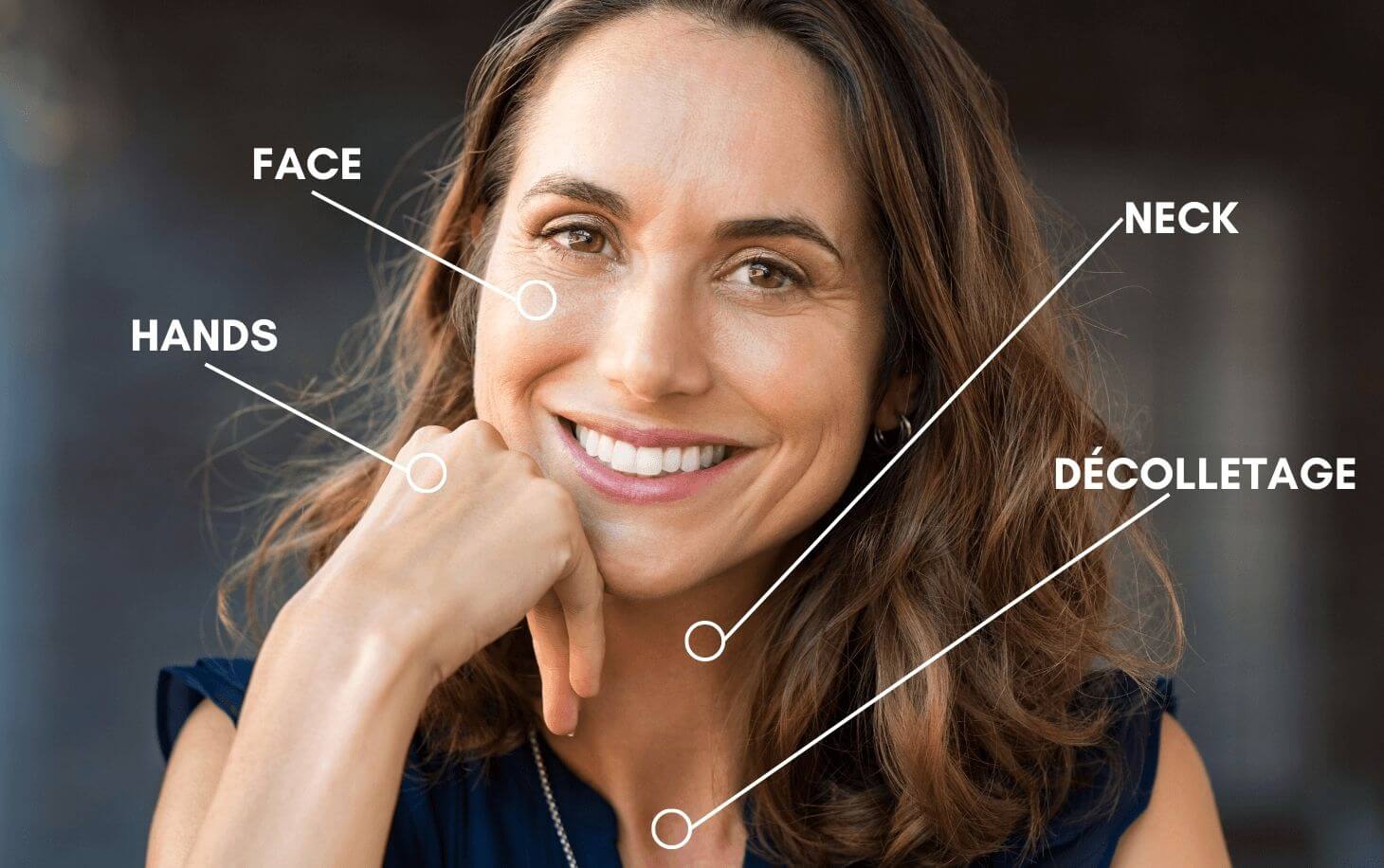 Woman's Face showing areas to have profhilo